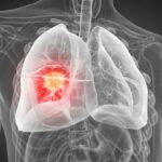 Lung Cancer Treatment in Kolkata