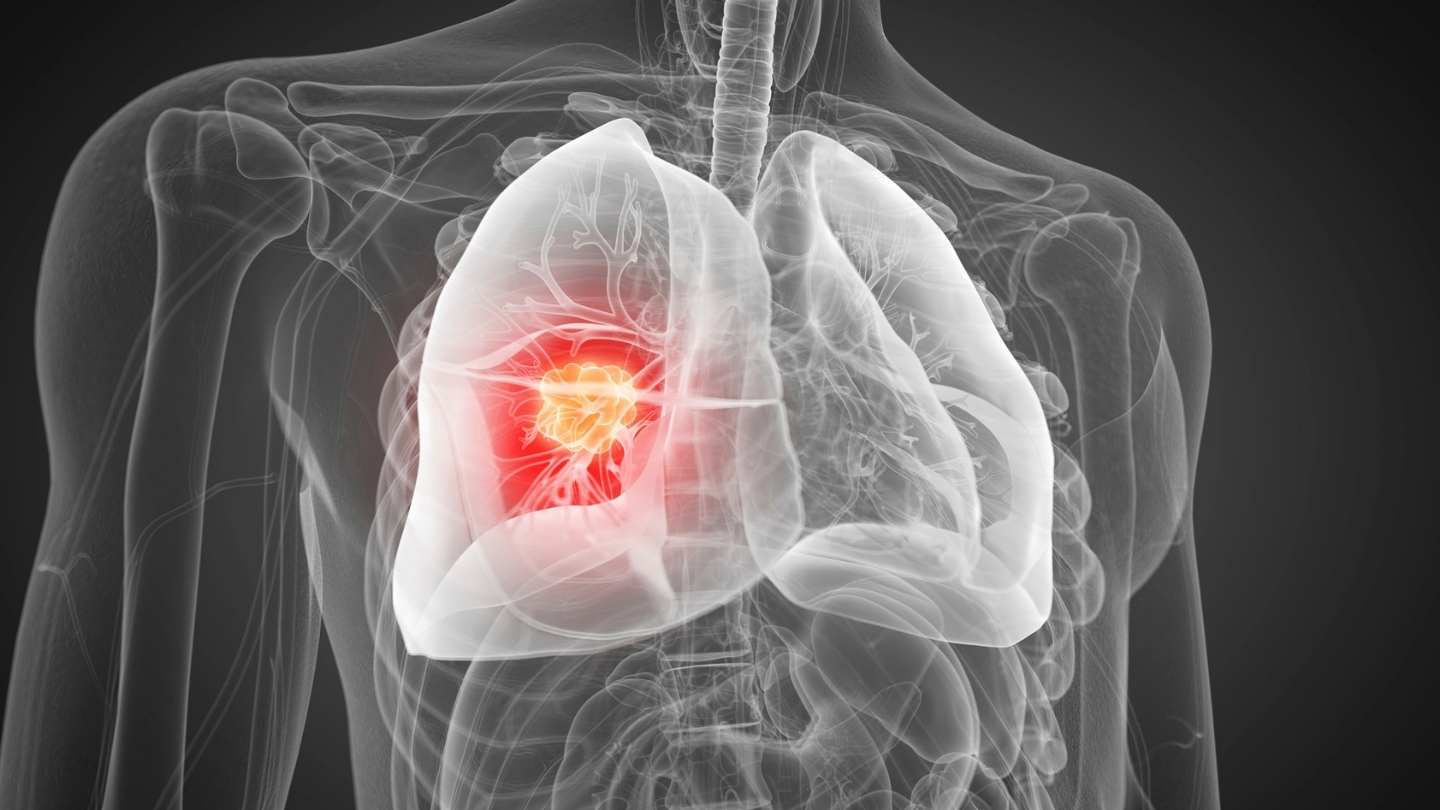 Lung Cancer Treatment in Kolkata