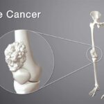 Bone Cancer Treatment in Kolkata